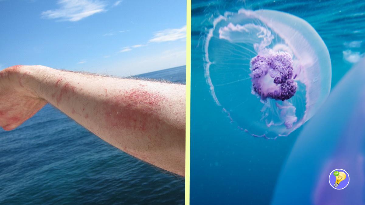 Piqûres de Méduse Remède Naturel et Rapide.